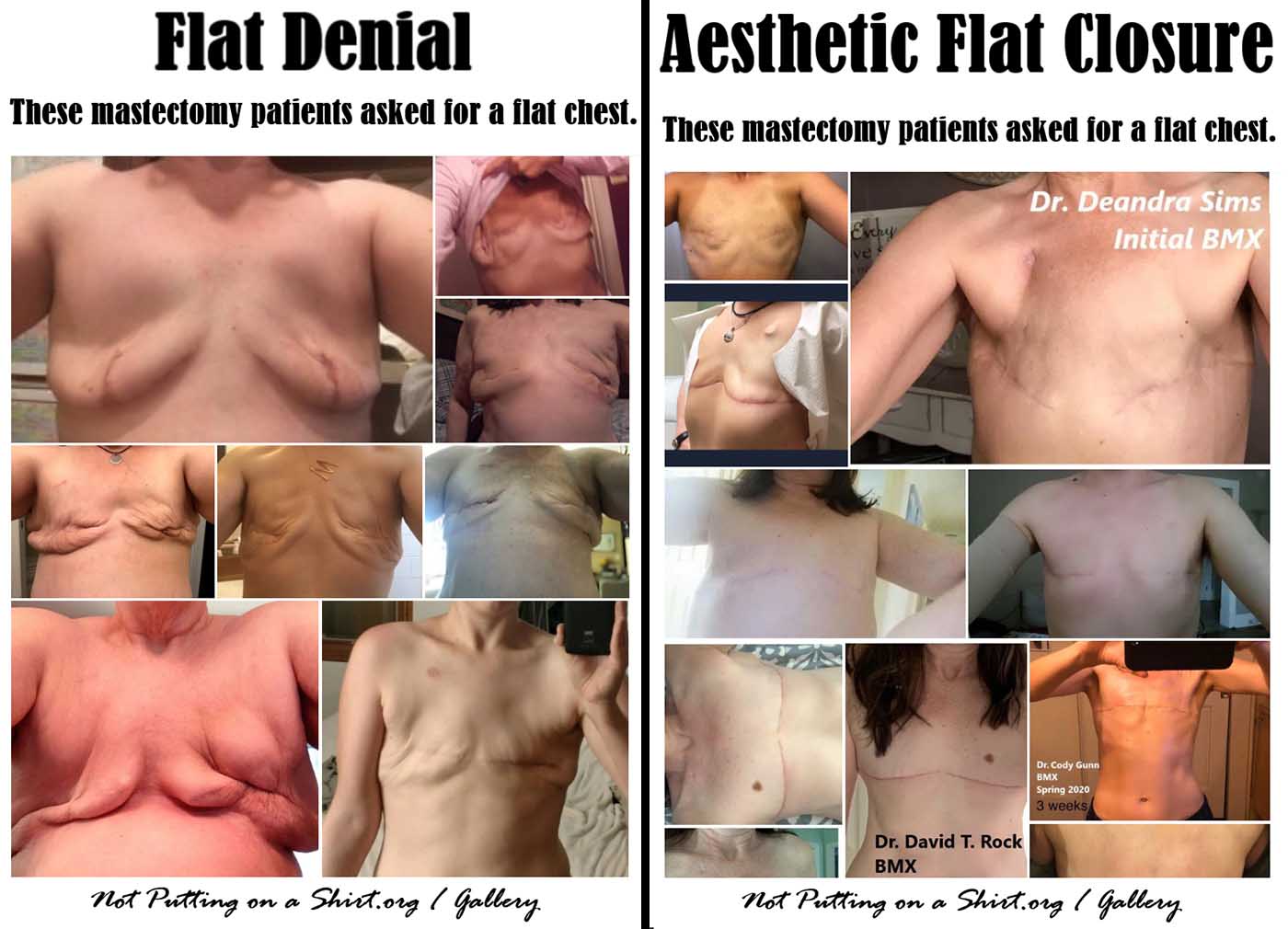 Not Putting on a Shirt - If you're facing mastectomy & considering going  flat, you should know that there are many ways to produce an aesthetic flat  closure (as defined by the